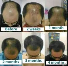 Hairloss