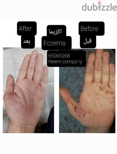 Eczema and acne natural creams اكزيما