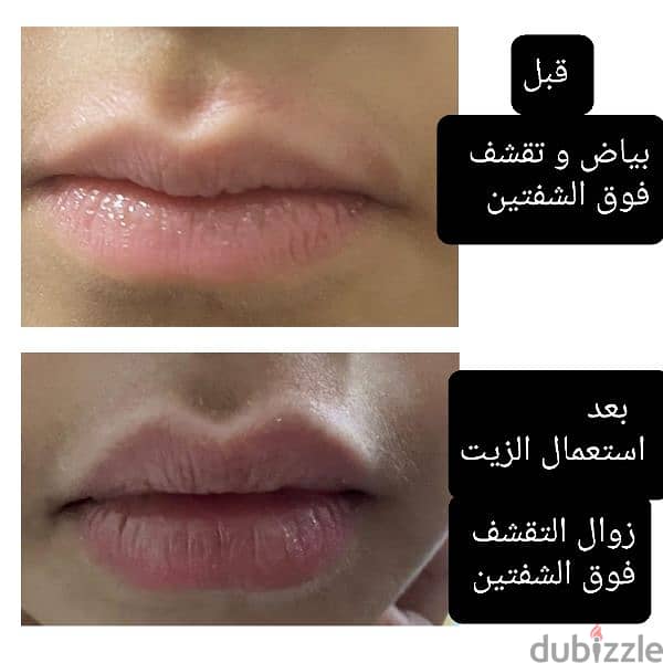 Eczema and acne natural creams اكزيما 2